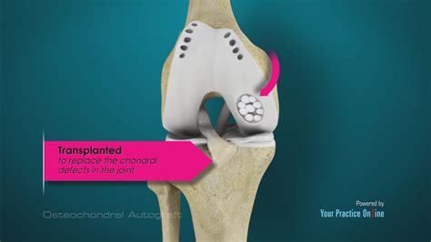  Osteochondraal Autograft Transplantatie: Een Revolutionaire Aanpak voor Kraakbeenherstel!